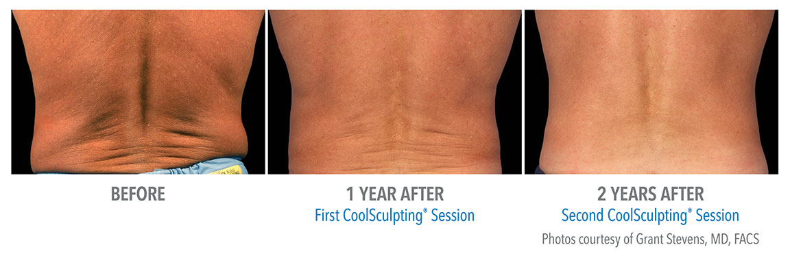 Na de CoolSculpting behandeling bij Centrum Oosterwal