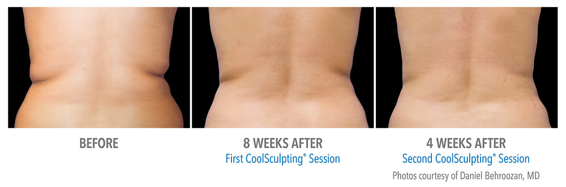 Na de CoolSculpting behandeling bij Centrum Oosterwal