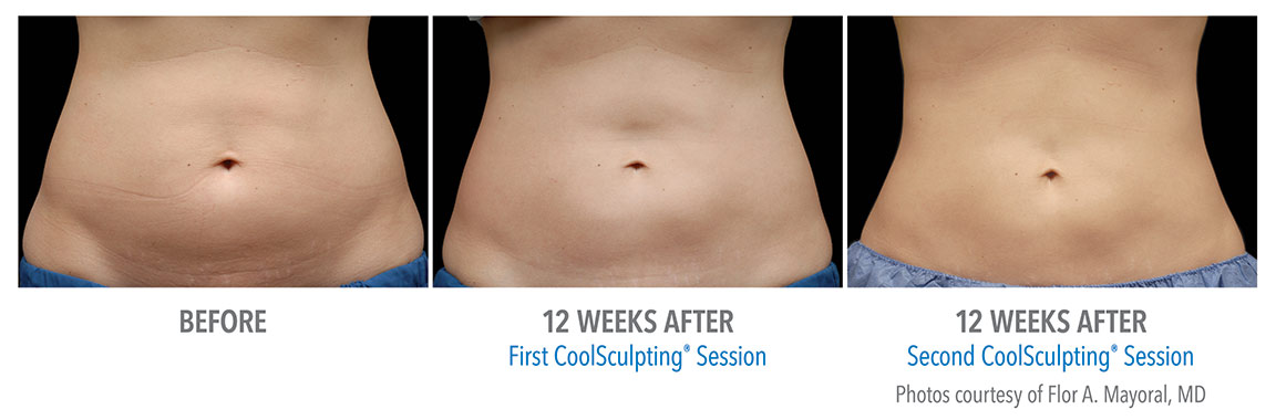 Na de CoolSculpting behandeling bij Centrum Oosterwal